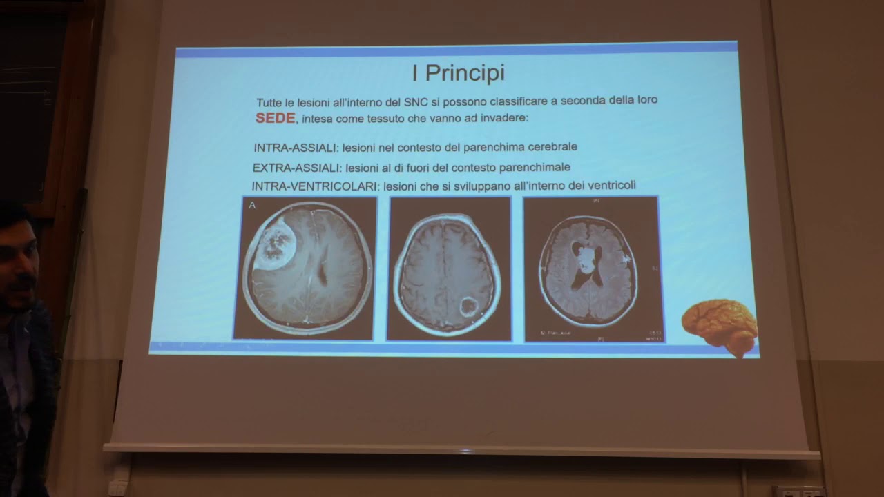 Neurochirurgia - Tumori intracranici