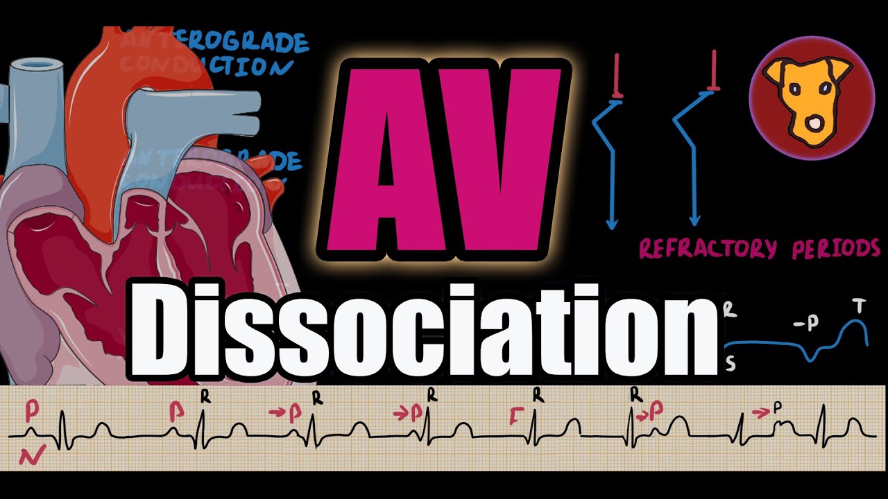 AV Dissociation EXPLAINED: Classification, Pathophysiology & ECG Criteria (Beginner&rsquo;s Guide)