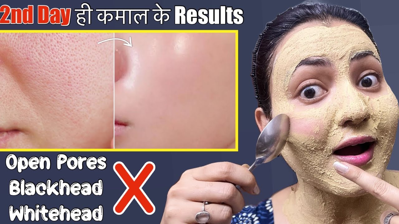 Skin Transformation Challenge (Day 2) : Remove Open Pores Blackhead Whitehead Naturally in 5 Days💕