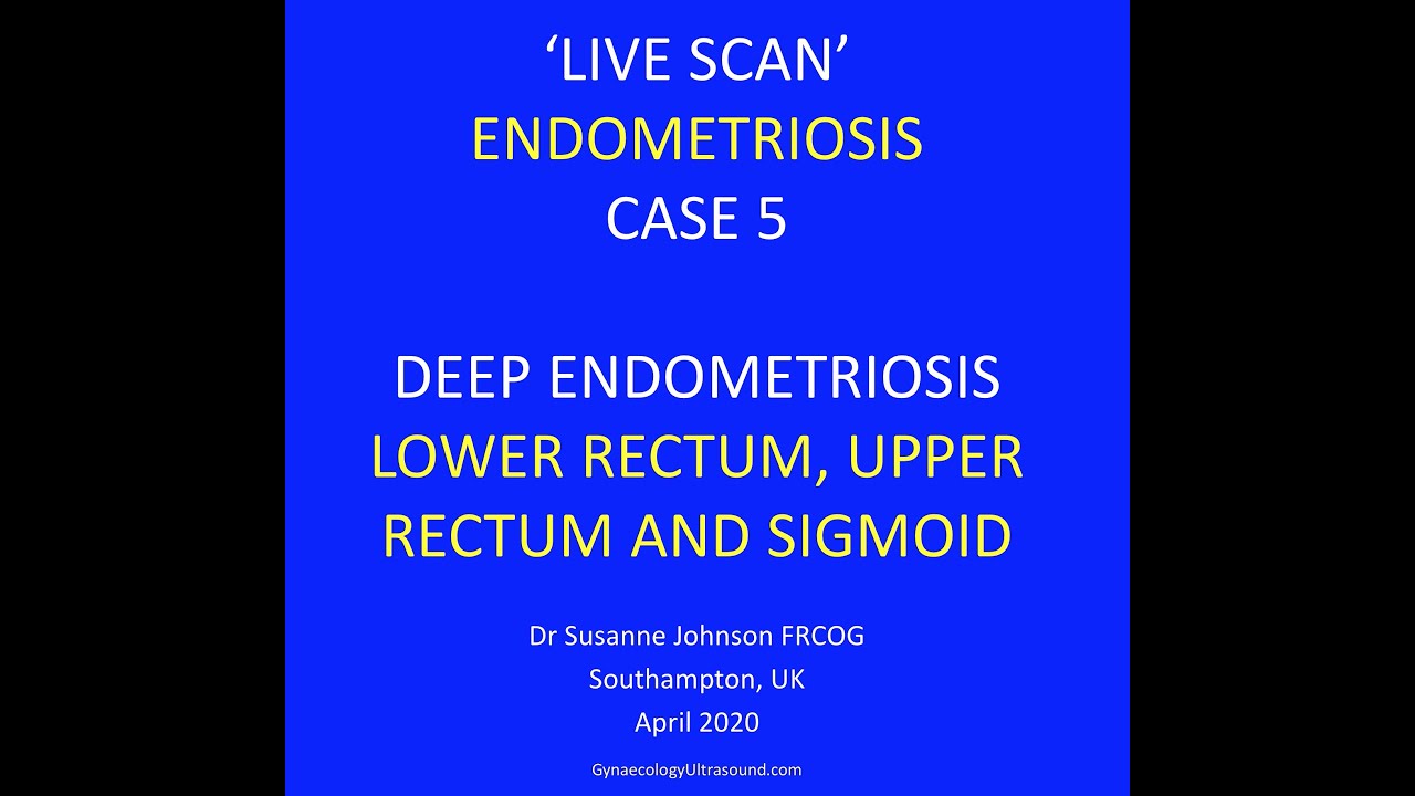 LIVESCAN 5 ENDOMETRIOSIS