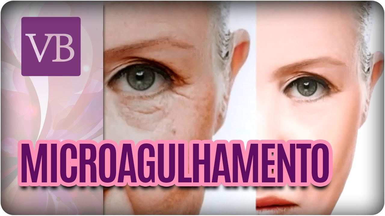 O que é microagulhamento? - Você Bonita (11/10/16)