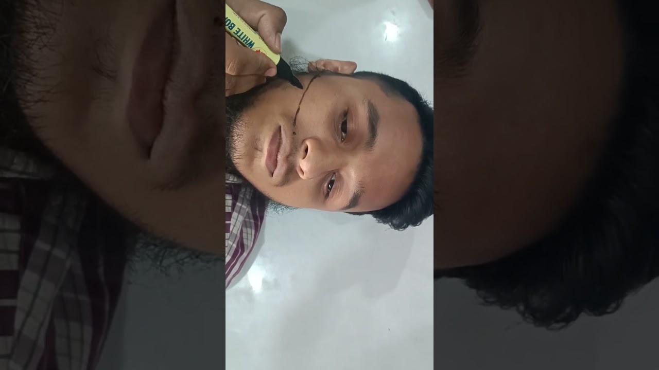 Surface Marking Of Parotid duct (Part -02)