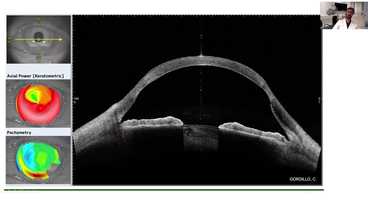 Lecture: Understanding Keratoconus: Comprehensive Diagnosis & Treatment Options
