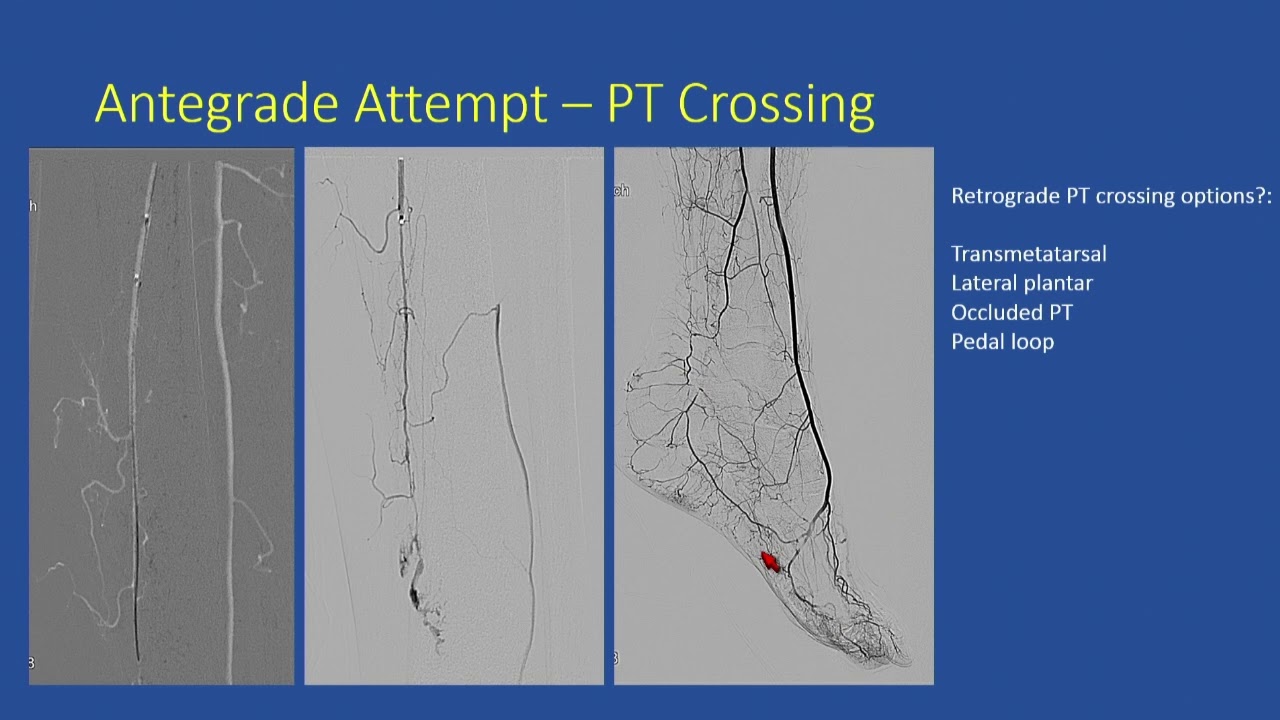 Case Discussion: Revascularization of Complex Infrapopliteal Disease w/Tibiopedal Access