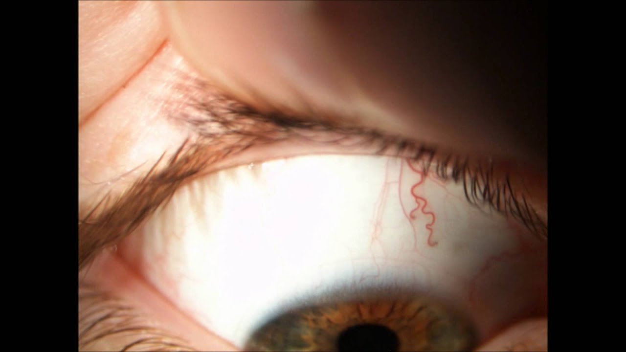 Contact Lenses - SCL Assessment of fit & Removal