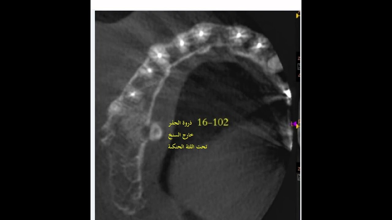 أهمية صورة ال cbct ثلاثية الأبعاد في تجنب التورط بجراحة غير لازمة