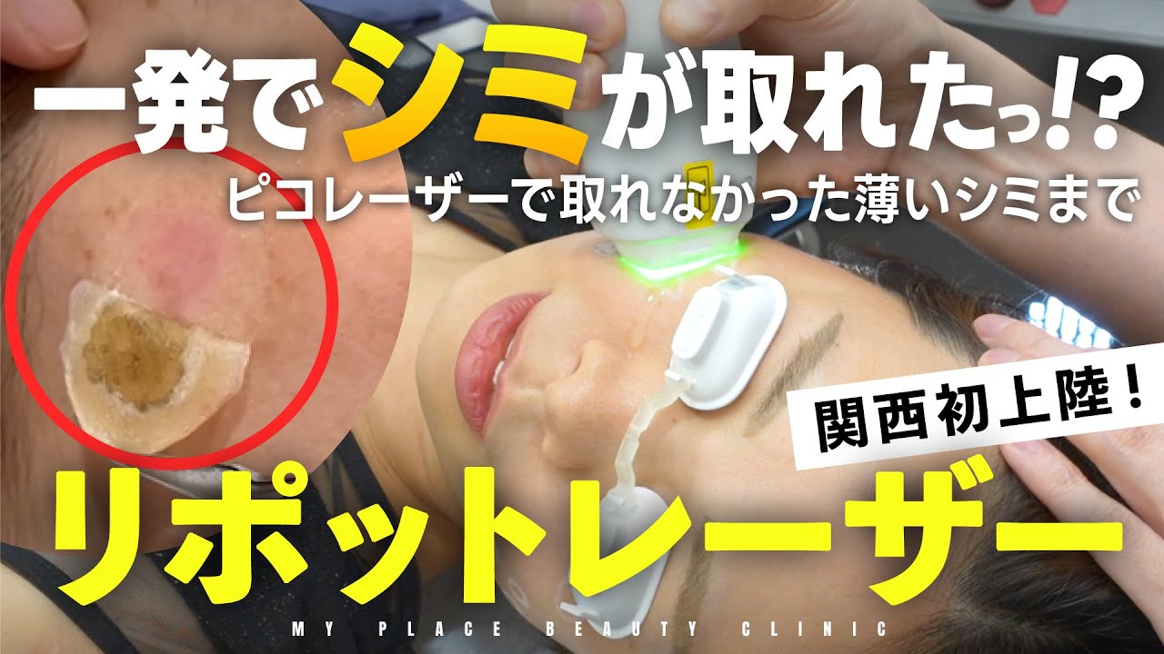 【シミ取り】韓国で大人気のリポットレーザーを関西初導入！痛くない＆即効性がスゴイ