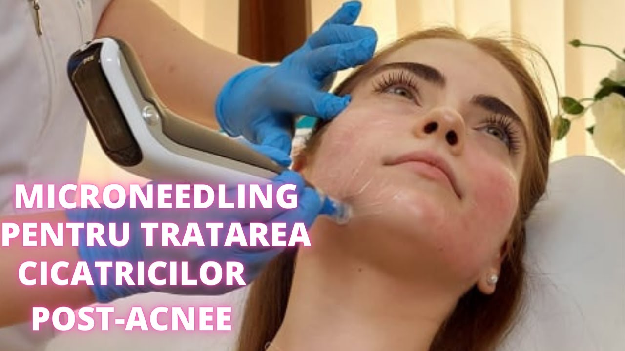 Microneedling (Dermapen) pentru tratarea cicatricilor post-acnee | DermaBeauty Clinique