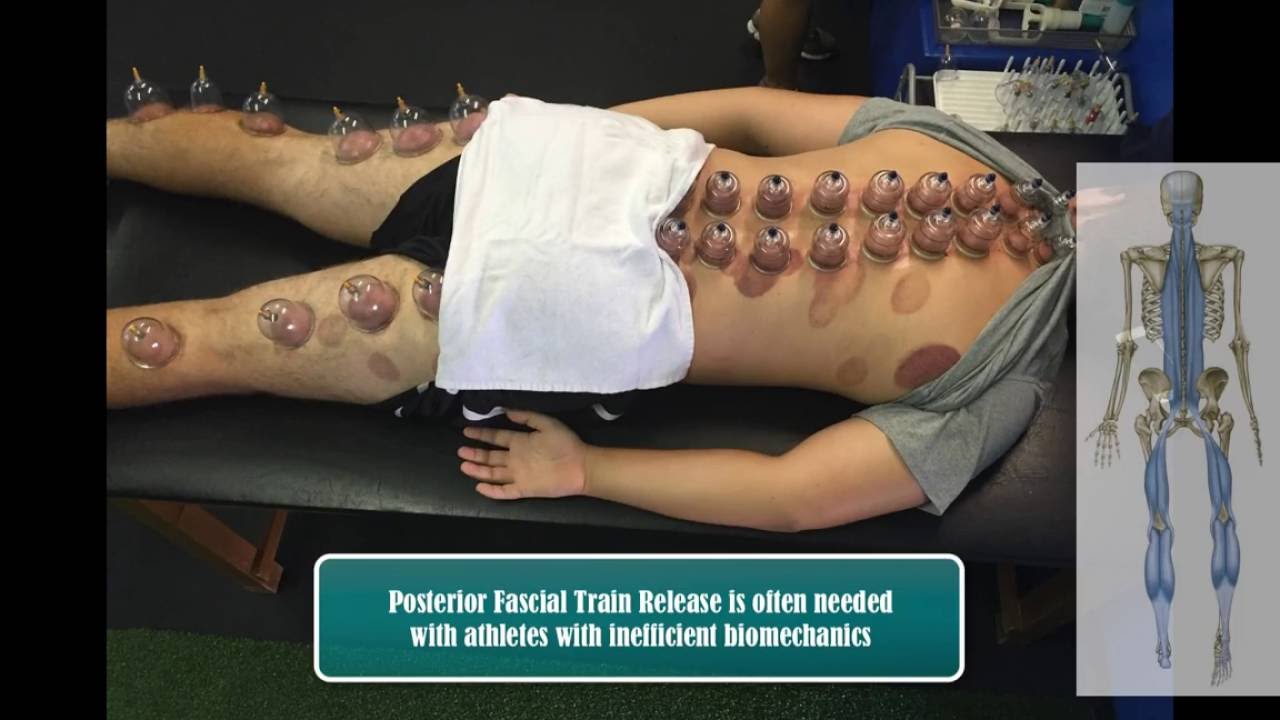 What is Cupping Therapy for Athletes and the Benefits