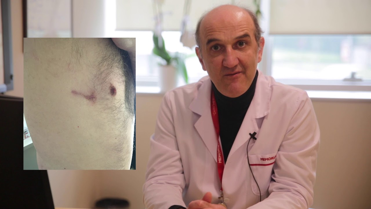 Is there a role for surgery in stage 3A Lung Cancer?
