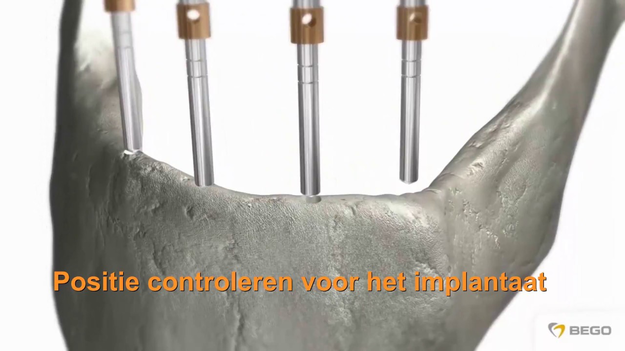 Hoe worden mini implantaten geplaatst