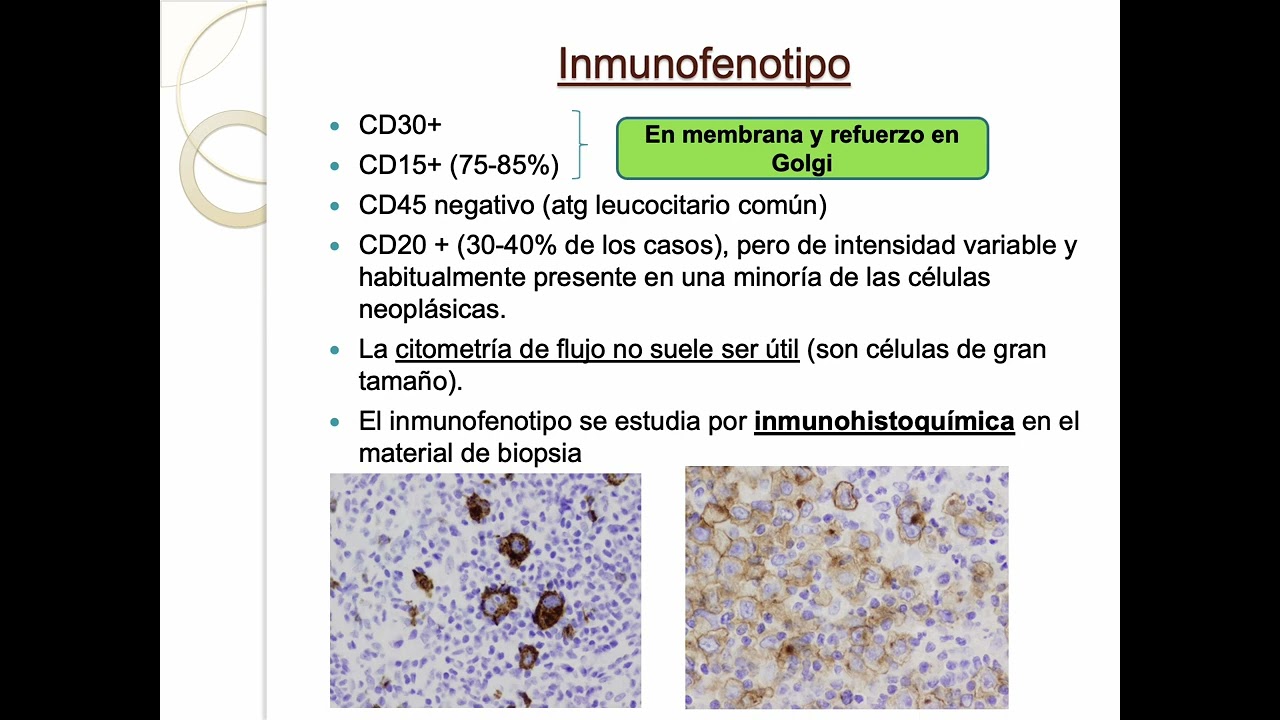 Linfoma de Hodigkin