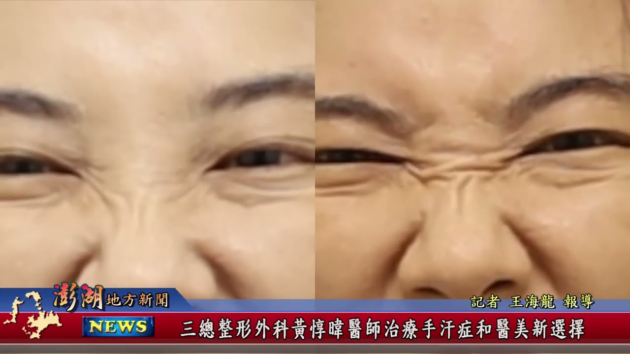115.1.27地方新聞：三總整形外科黃惇暐醫師治療手汗症和醫美新選擇