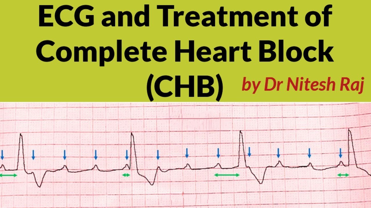 Complete heart block (CHB) and ECG #drniteshraj
