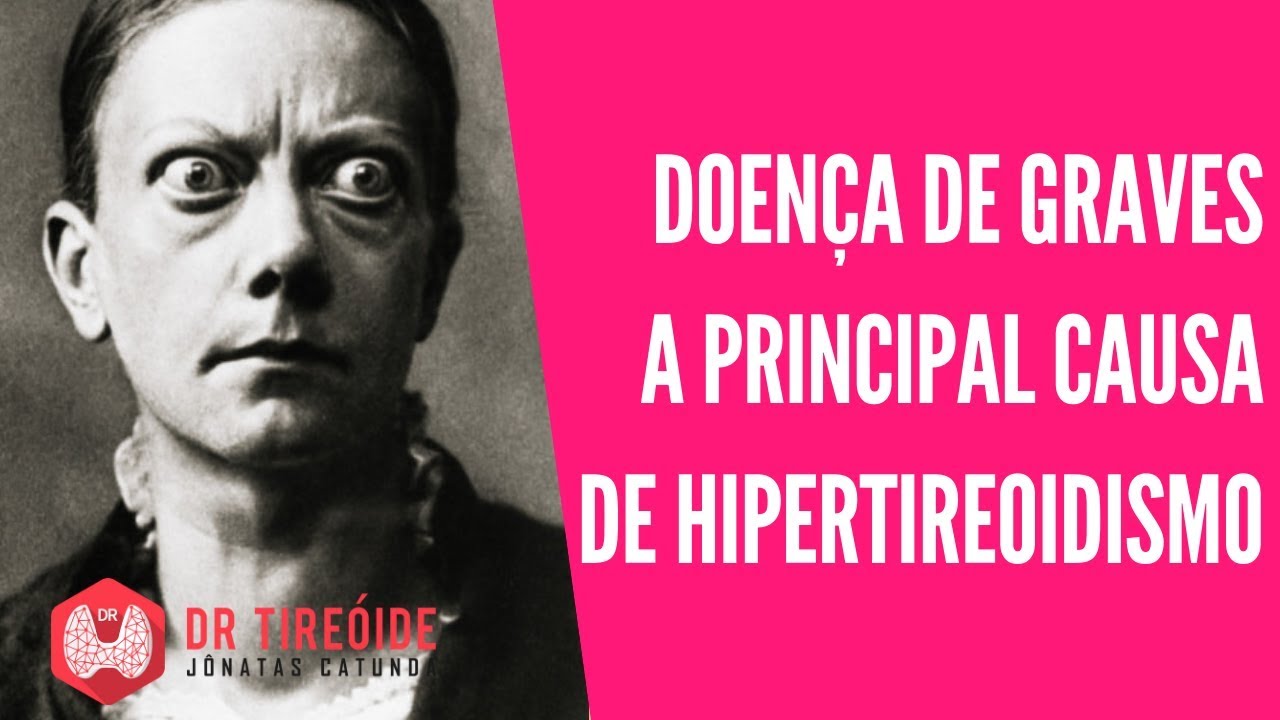 Doen&ccedil;a de Graves, a causa mais comum de Hipertireoidismo | Dr J&ocirc;natas Catunda