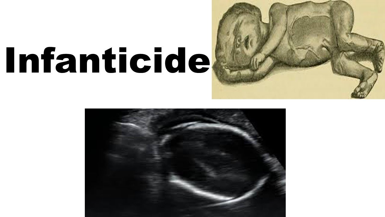 Infanticide- Definition, Still birth, Dead born