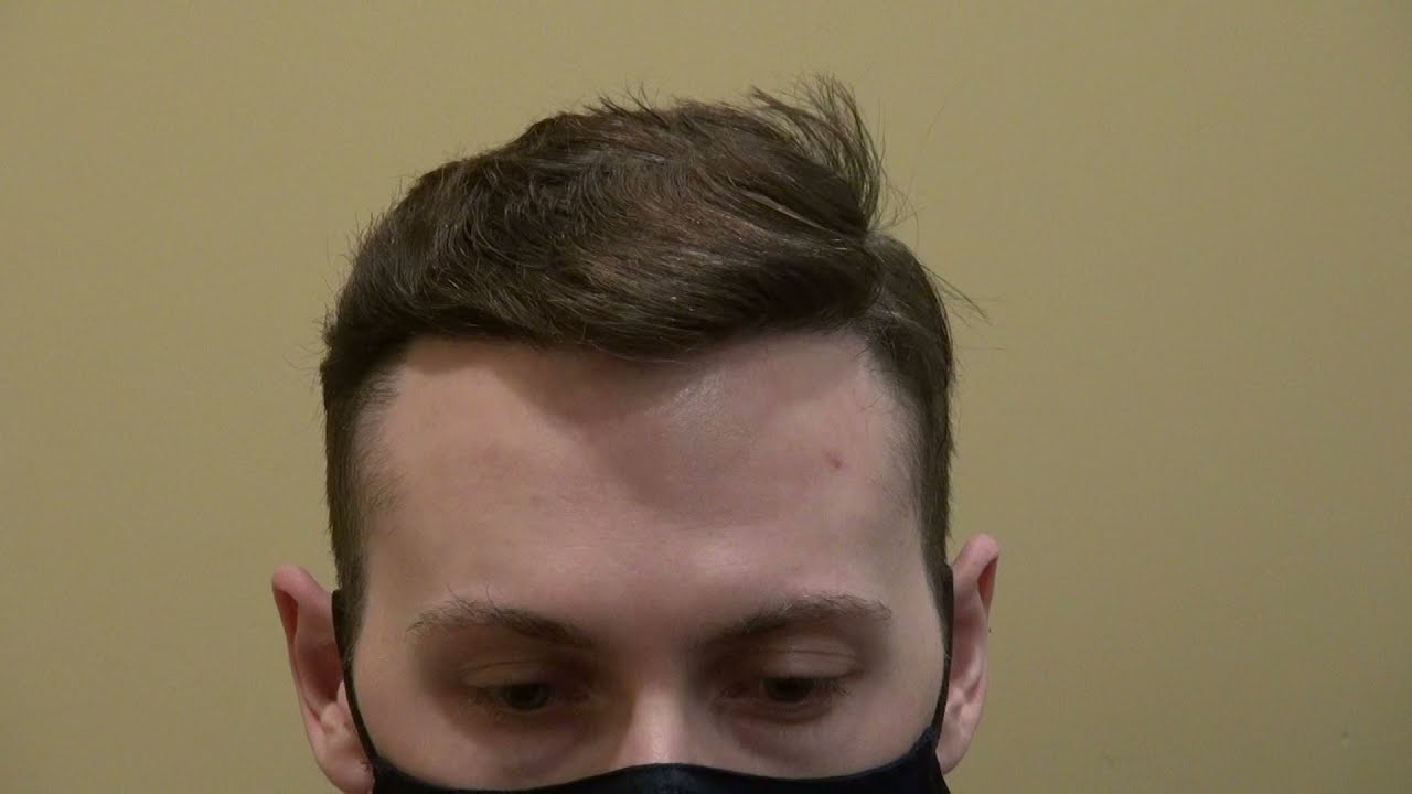 (Before & After) Receding Temple Corners Hair Restoration Procedure by Dr. Diep