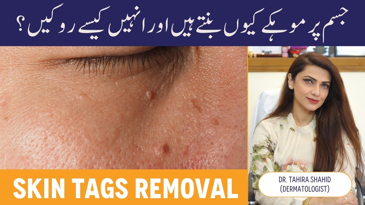 SKIN TAGS Causes & Solution - Moko Ka Ilaj Kaise Karen - Skin Tags Removal - Skin Tag Banne Ki Wajah
