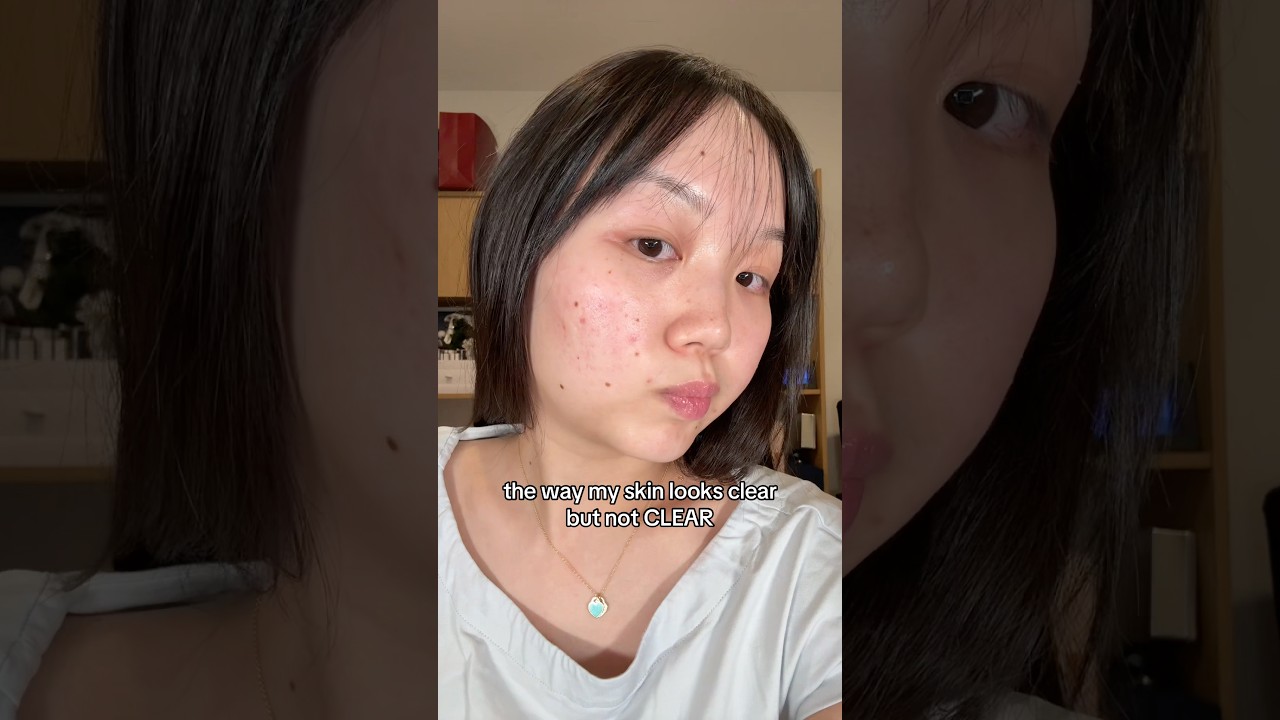 Why did no one warn me about acne scars?😔😩 #acne #acnescars #clearskin