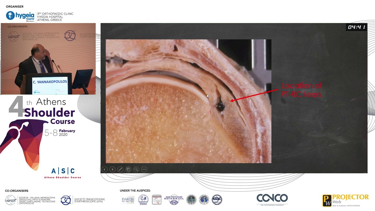 Partial thickness rotator cuff tears. Treatment options - Christos Yiannakopoulos