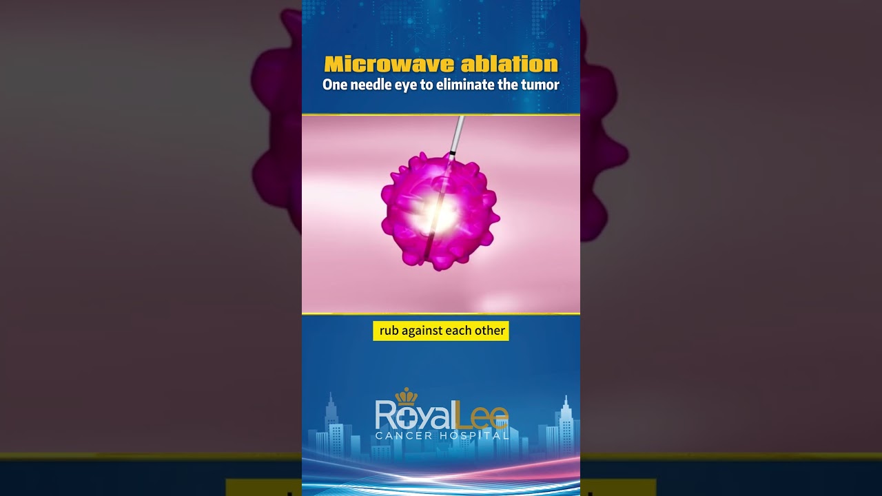 Microwave Ablation | RoyalLee Cancer Hospital