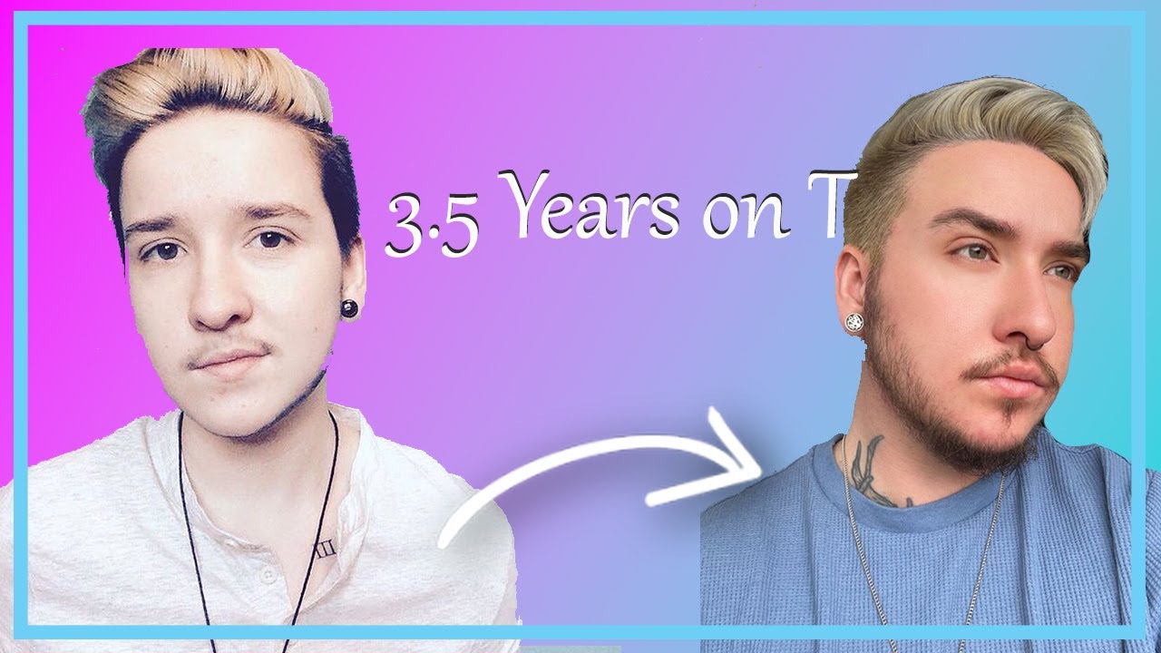FTM- 3.5 YEARS ON T