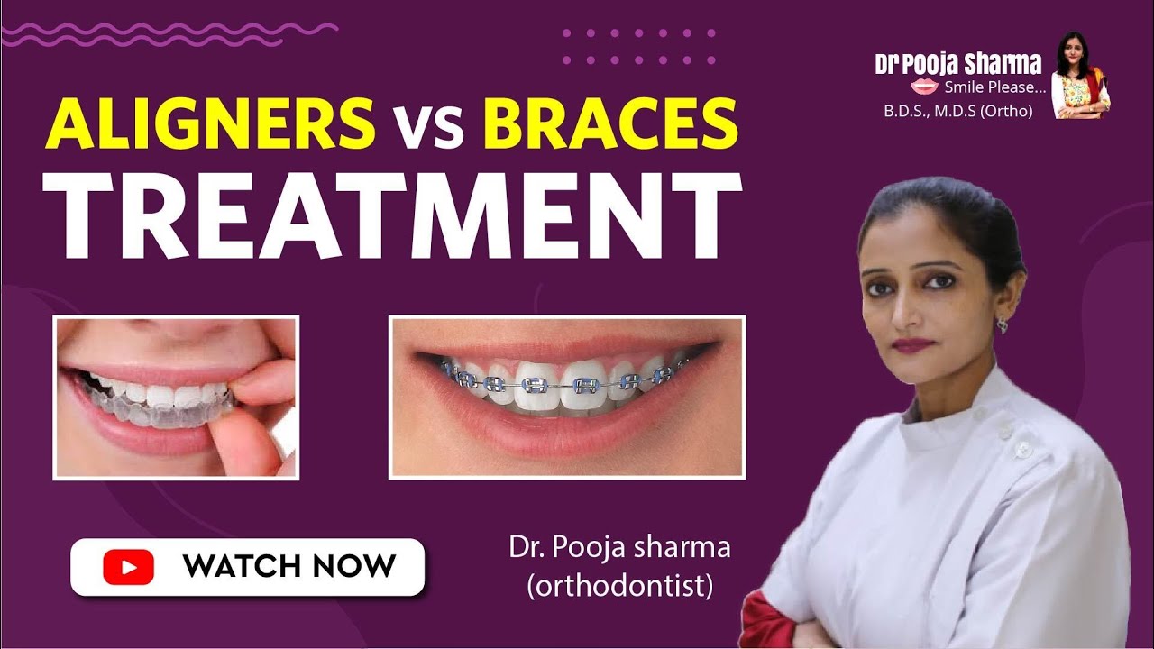 Aligners vs Braces Treatment || Which is best? Orthodontic in Agra, India || Dr Pooja Sharma