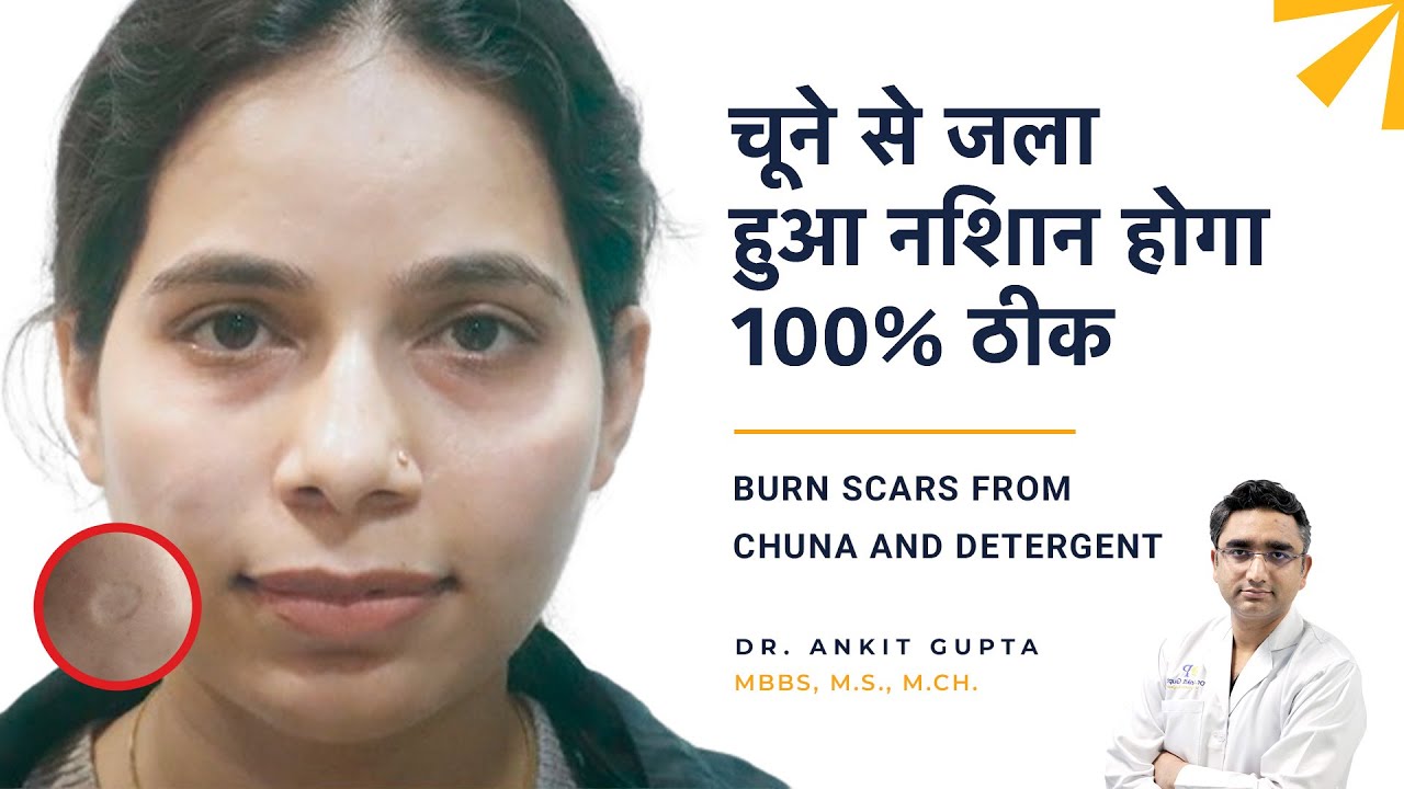 Scars from chuna and detergent | सर्फ, चूने, पेट्रोल से जले दागों का इलाज! #scarremoval #scar