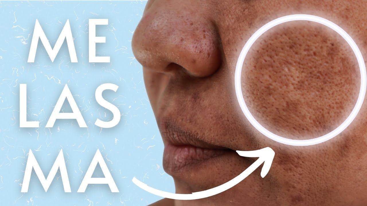ÁCIDO MANDÉLICO para clarear melasma e manchas de Acne