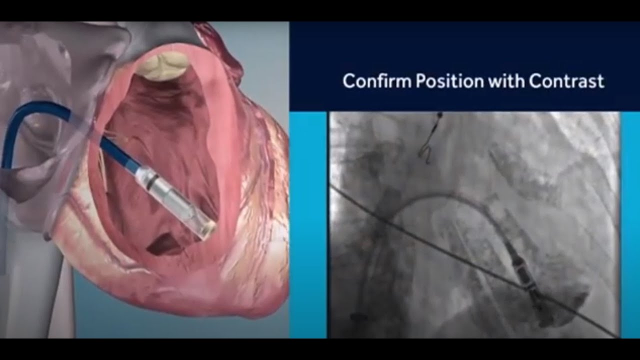 Weekly Checkup - Leadless Pacemaker