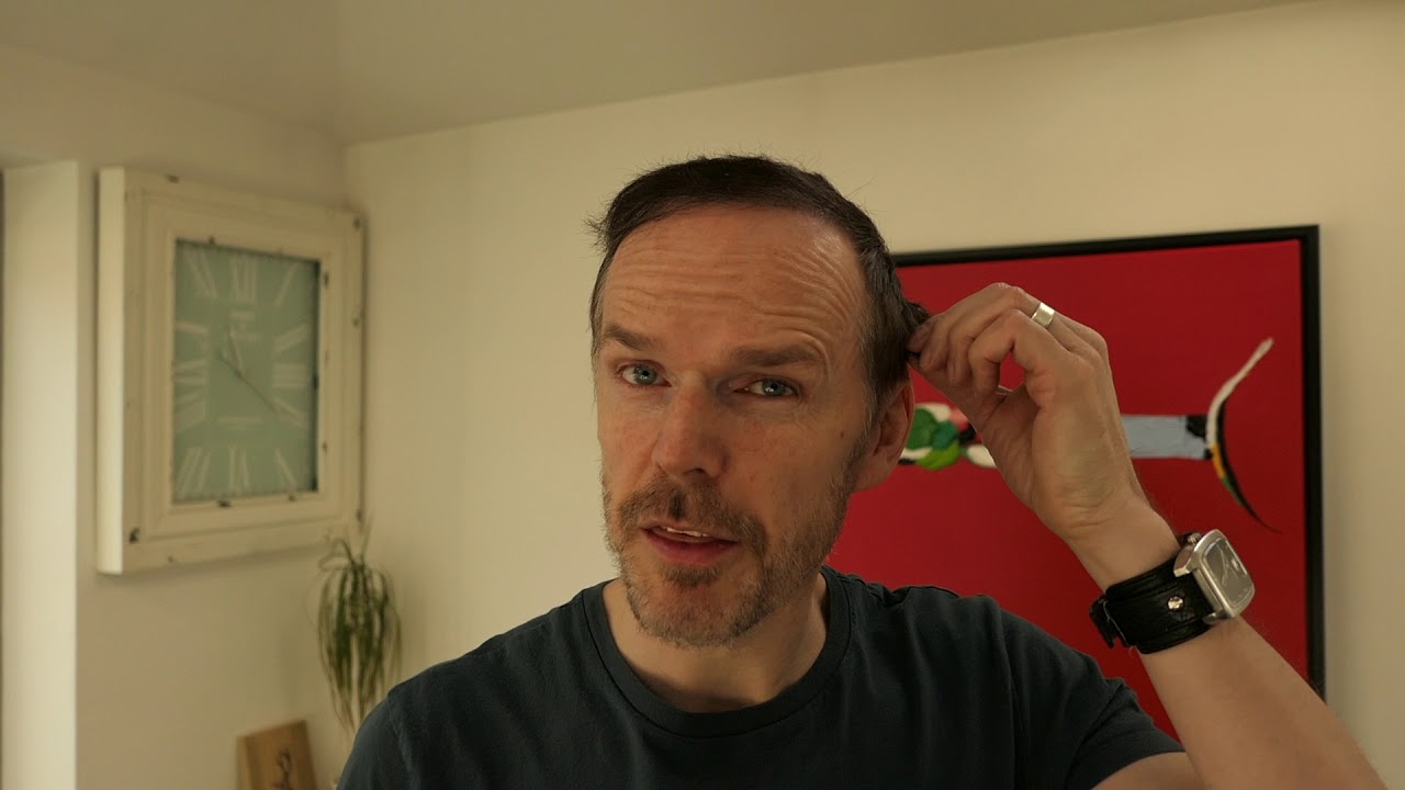 10 MONTHS AFTER MY HAIR TRANSPLANT