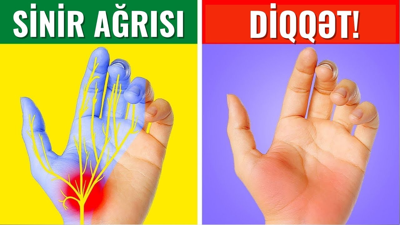 Əldə Sinir Ağrıları - BUNA DİQQƏT EDİN! #neyrocerrah #beyincerrahı #onurgacerrahı #drbehruzeyvazov