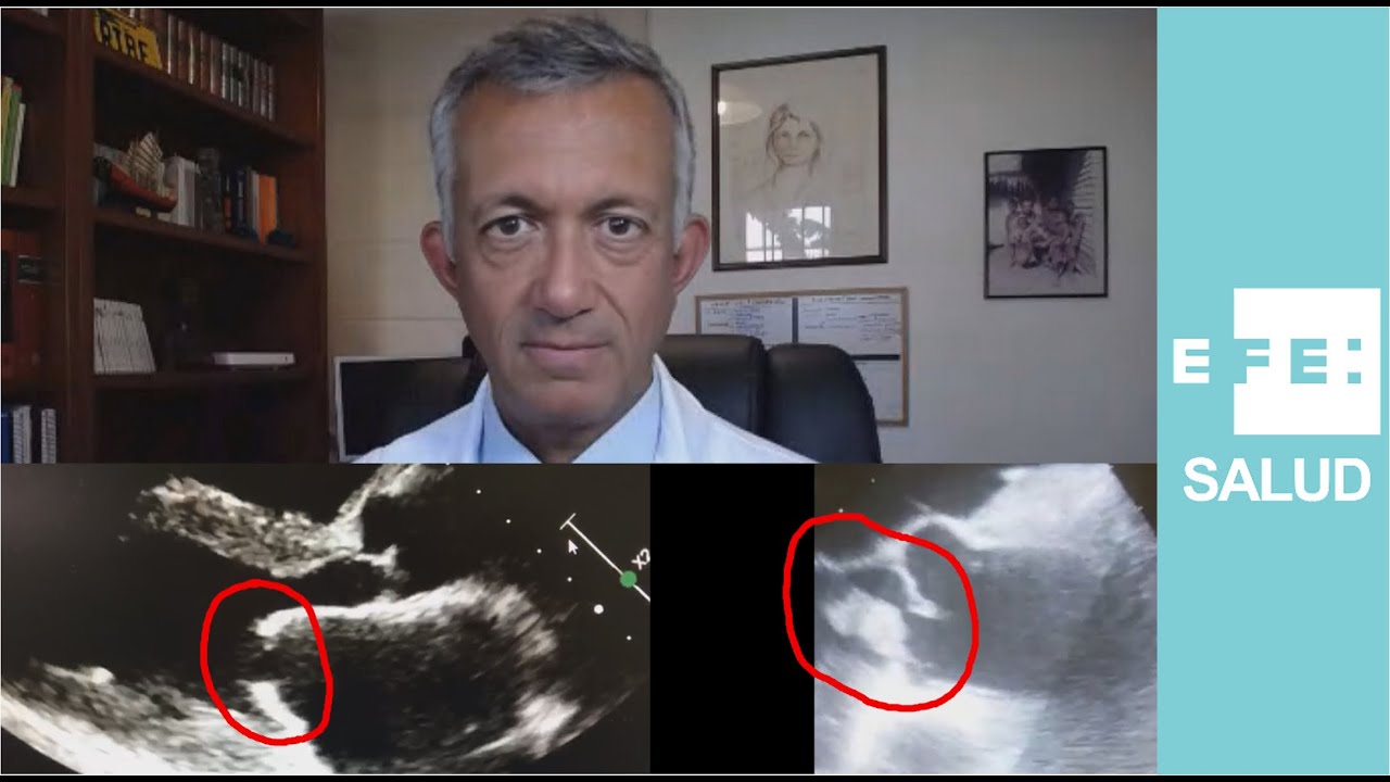Los desvelos por las cuatro válvulas cardíacas: tricúspide, pulmonar, mitral y aórtica