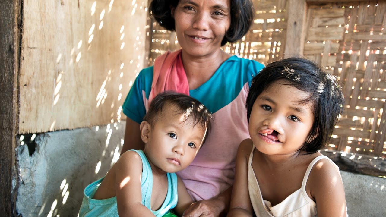 Discovering the Causes of Cleft