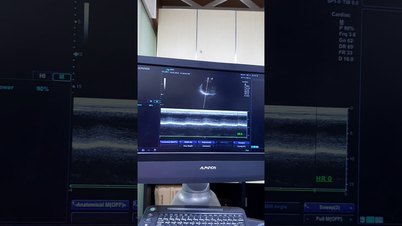 ALPINION ULTRASOUND MACHINE