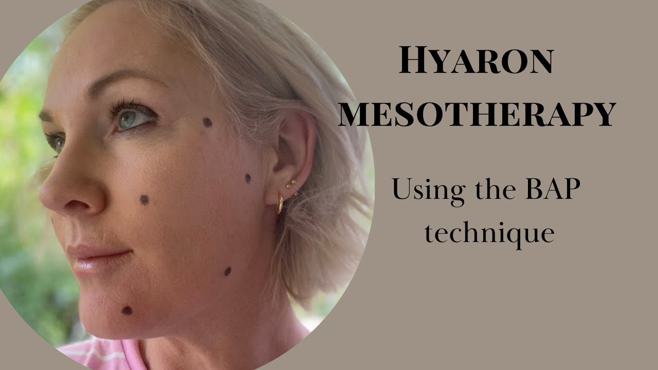 Hyaron skin booster | Mesotherapy, using the BAP technique.