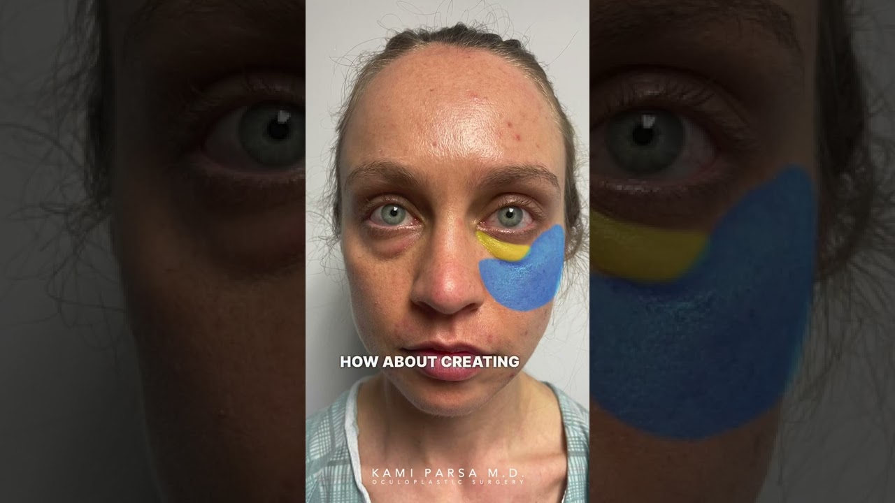 Блефаропластика век с пересадкой жира в Лос-Анджелесе, естественный результат | Доктор Ками Парса...