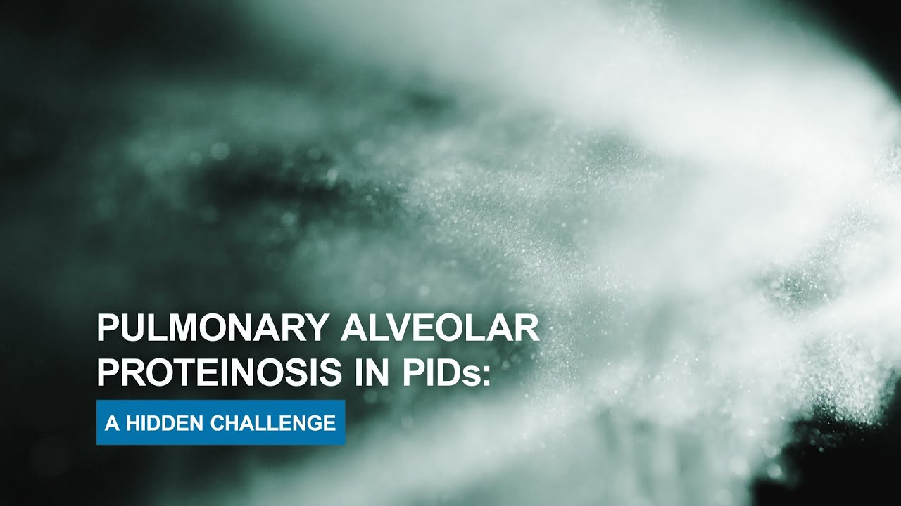 MINI-DOC: «Pulmonary Alveolar Proteinosis in PIDs: A Hidden Challenge»