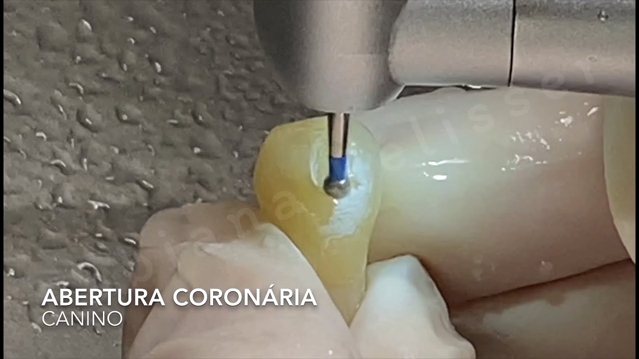 ABERTURA CORONÁRIA DE CANINO SUPERIOR - Professora Fabiana Vier Pelisser