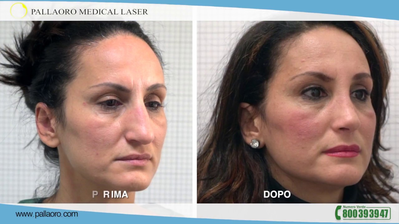 Rinoplastica su naso troppo grande con gibbo JACQUELINE Rinoplastica