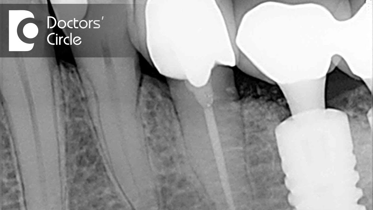 Methods & Options of Re RCT - Dr. Manesh Chandra Sharma