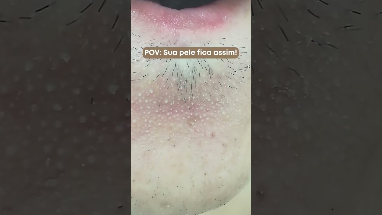 A sua pele est&aacute; assim: excesso de oleosidade, poros dilatados, cravos e acne?