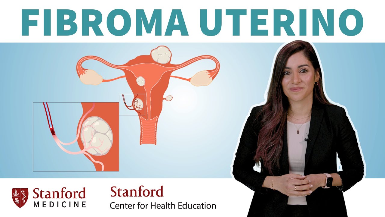 Fibromas Uterinos: Sintomas, Causas, y Tratamientos | Stanford