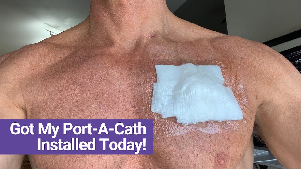 Сегодня утром установили Port-A-Cath!