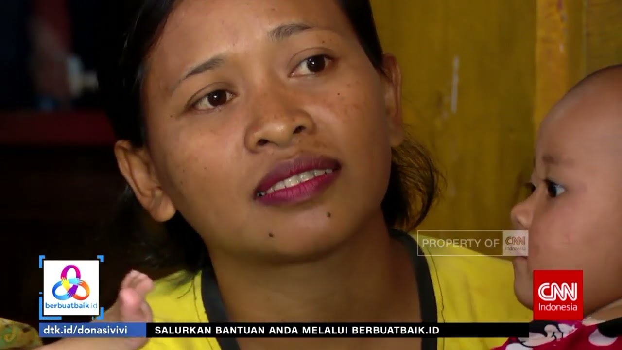 Perjuangan Hidup Bocah Hidrosefalus