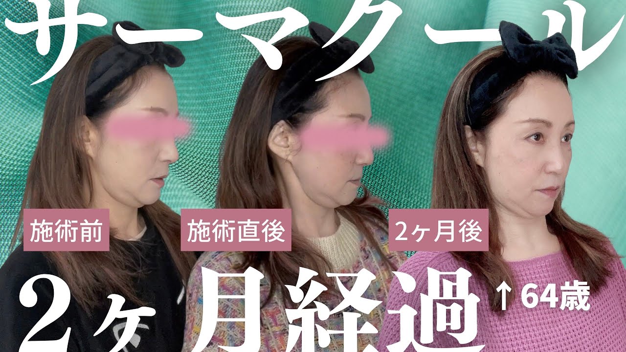【サーマクール2ヶ月経過】🔥サーマクール後ご報告❗️効果は。。。。