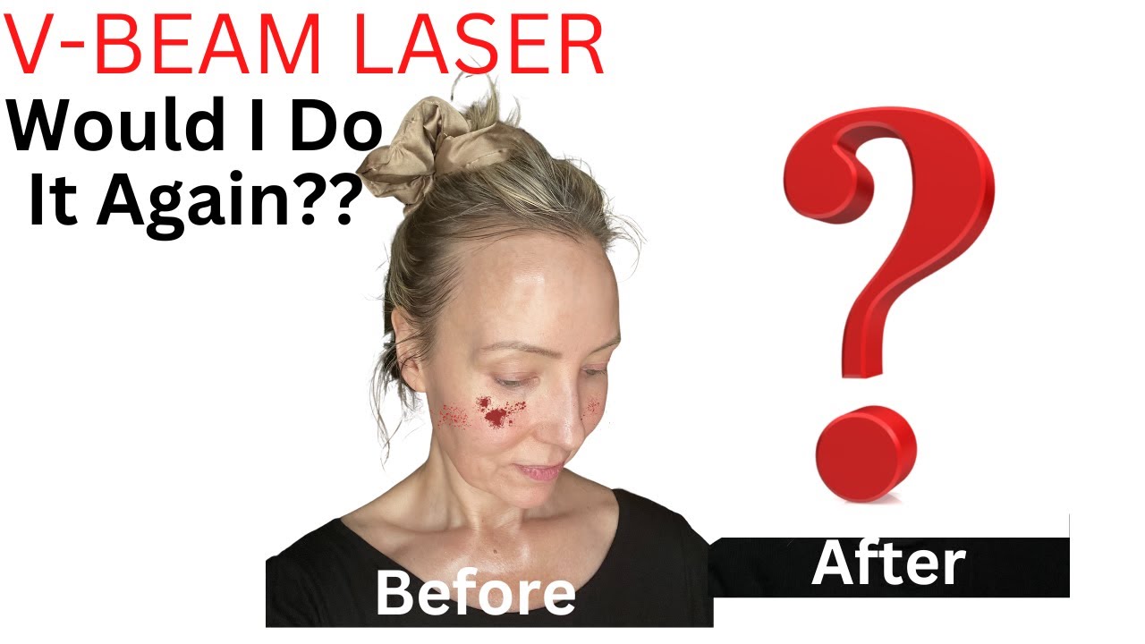 MY V-BEAM LASER EXPERIENCE: Would I Do It Again?
