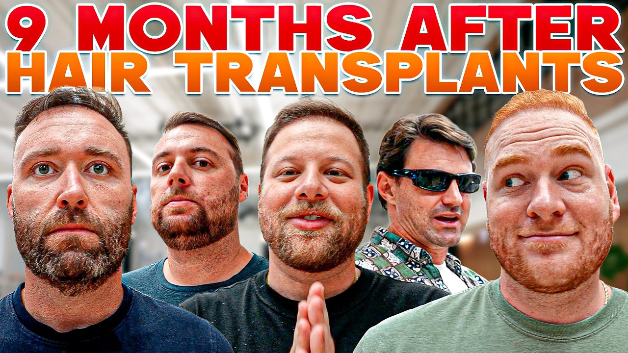 I Helped Them Get Hair Transplants… Here’s What They Look Like Now! | BALDSTOOL REUNION