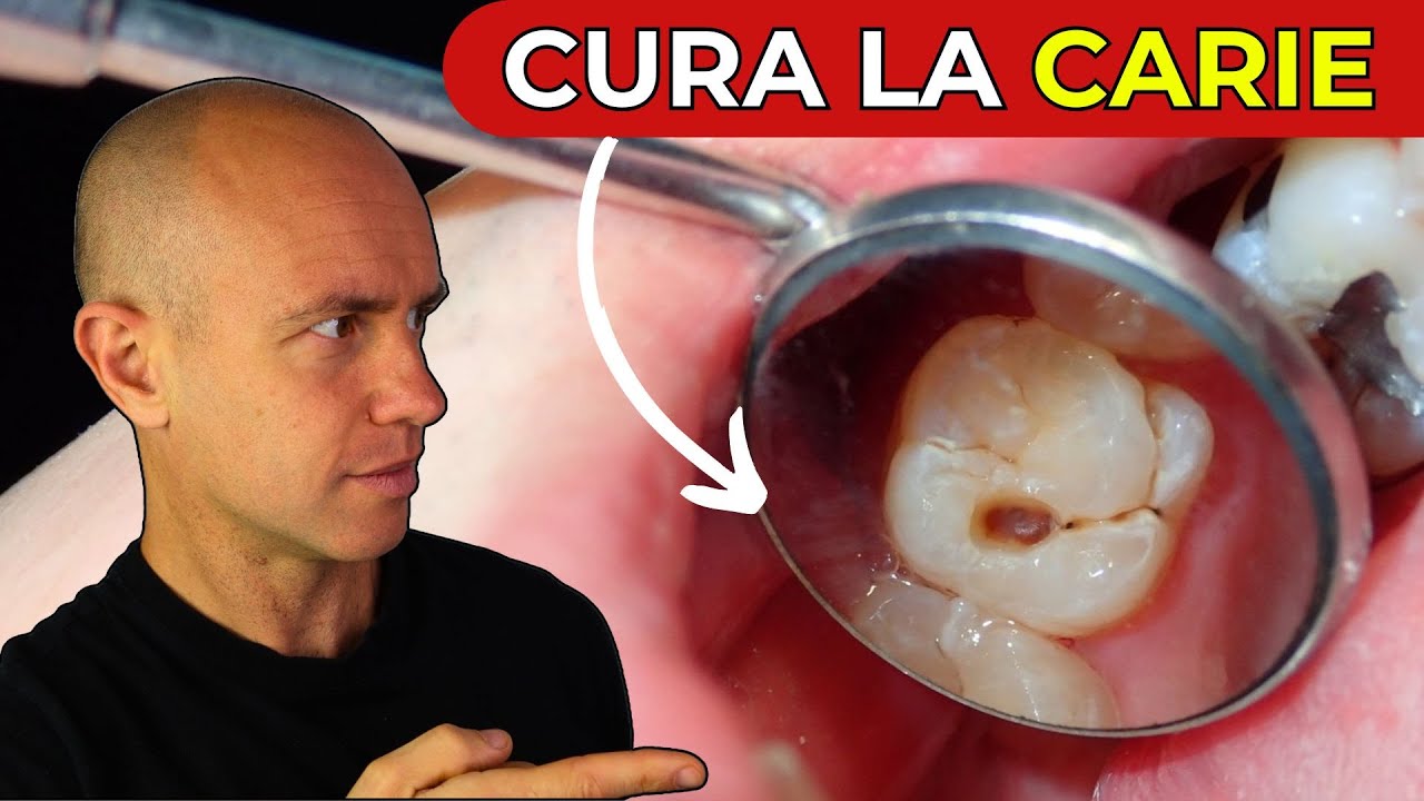Come CURARE una CARIE