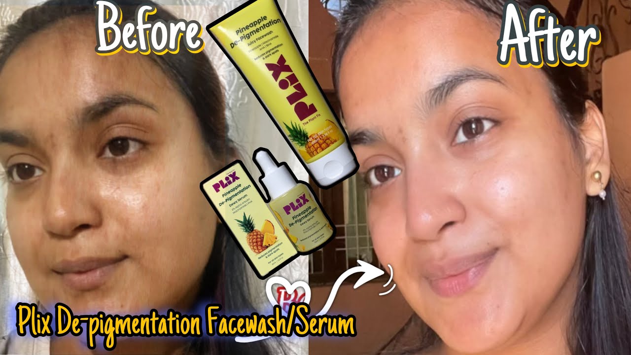 How I Got Rid of Pigmentations and Dark Spots by using Plix Pineapple Facewash & Serum❤️😍